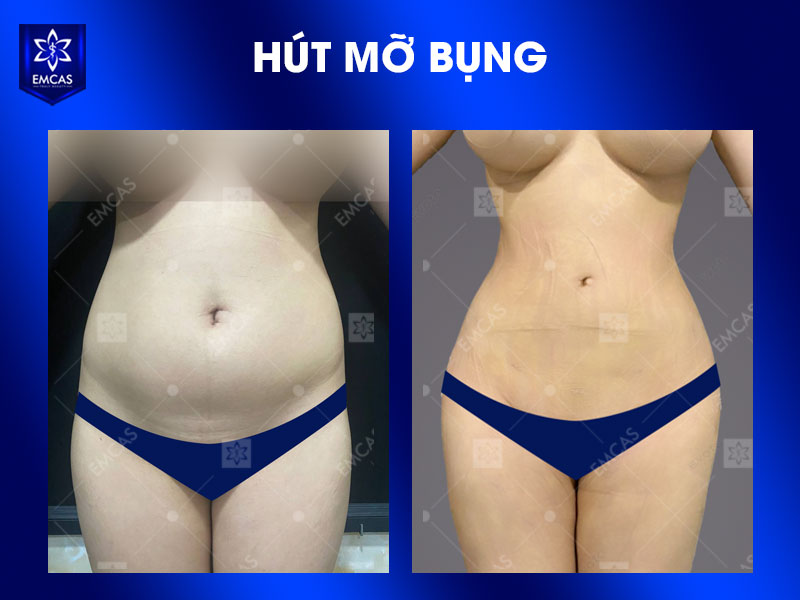 Tại Bệnh Viện Thẩm Mỹ EMCAS, kiểm soát an toàn hút mỡ được thực hiện theo hướng đánh giá cá nhân hóa