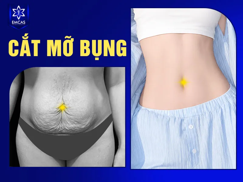 Thực hiện cắt mỡ bụng an toàn cần tại Bệnh Viện Thẩm Mỹ EMCAS