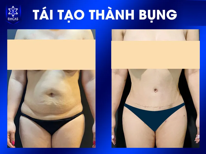 Nếu đau, sưng, đỏ hoặc dịch vết mổ ngày càng nhiều hơn thay vì cải thiện, bạn nên liên hệ bác sĩ.