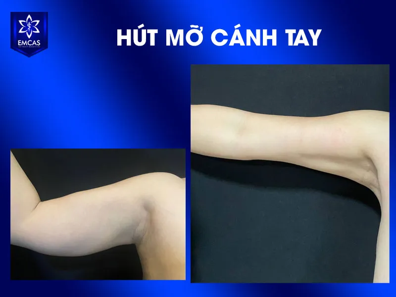 Thời gian lành sau hút mỡ không giống nhau vì mỗi người có vùng hút, lượng mỡ xử lý, cơ địa, sức khỏe nền