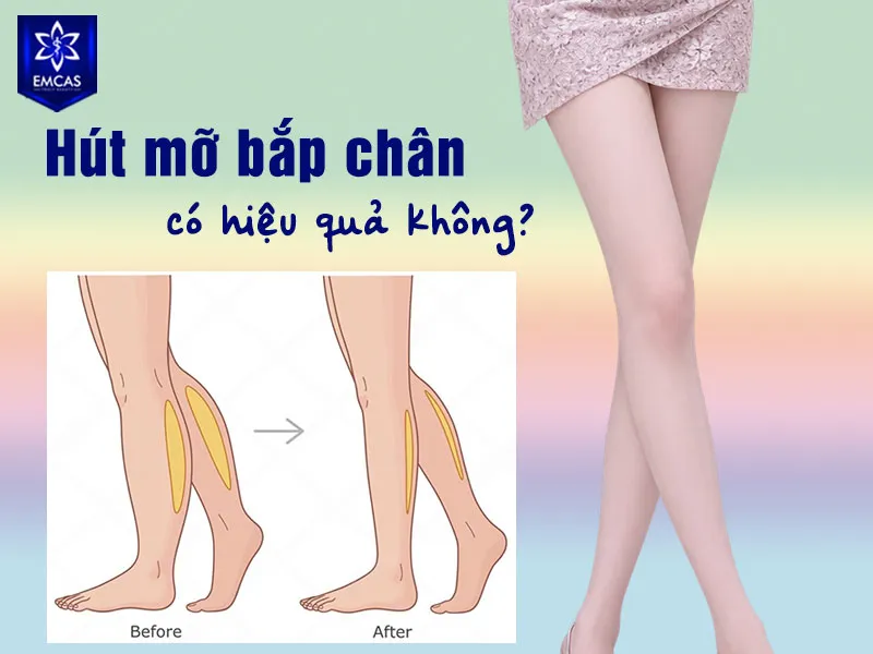 Hút mỡ bắp chân có thể cải thiện đường nét cẳng chân khi nguyên nhân chính là mỡ dưới da