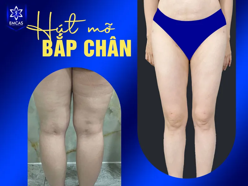 Hút mỡ bắp chân là phẫu thuật hút mỡ sử dụng ống hút chuyên dụng để loại bỏ một phần mỡ dưới da ở vùng cẳng chân dưới gối