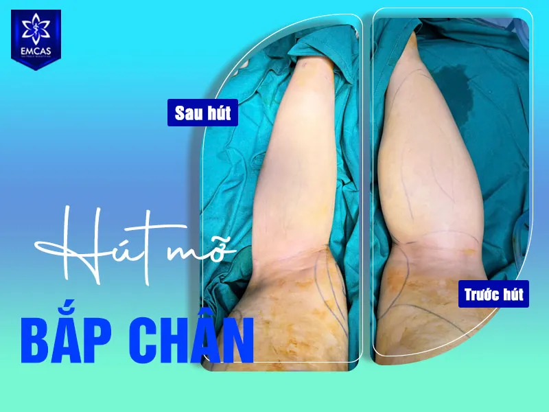 Hút mỡ bắp chân tại EMCAS được thực hiện trong mô hình bệnh viện có bác sĩ phẫu thuật với nhiều năm kinh nghiệm