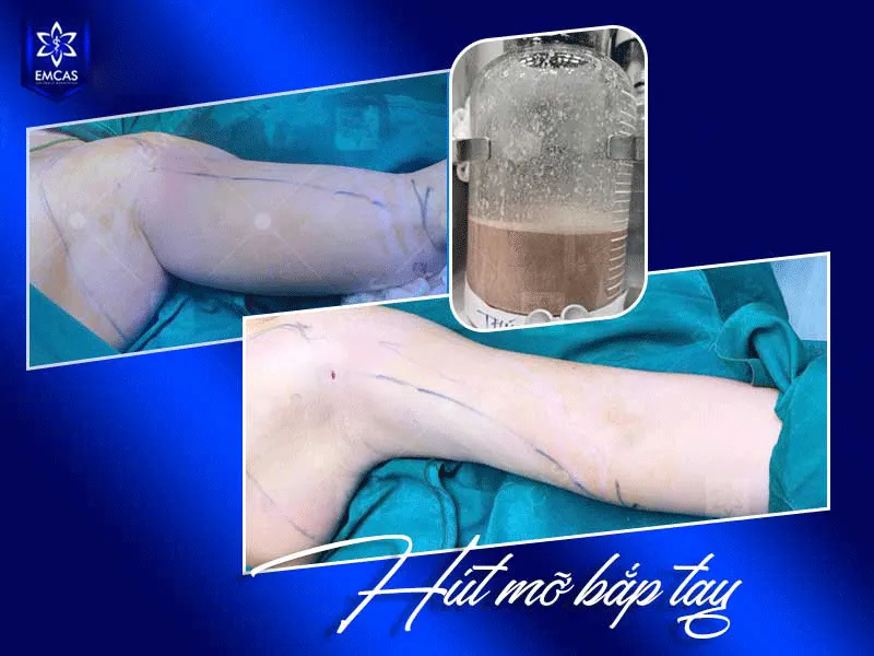 Sau hút mỡ bắp tay, cánh tay có thể bắt đẹp và thấy form rõ hơn từ khoảng 4 – 6 tuần