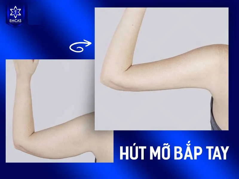 Hút mỡ bắp tay chỉ nên được thực hiện khi bắp tay to chủ yếu do mỡ thừa khu trú