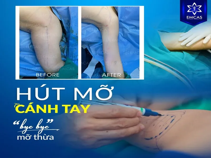 Không nên tự giảm hoặc ngừng đeo gen chỉ vì đã đủ số tuần hoặc thấy bắp tay bớt sưng.