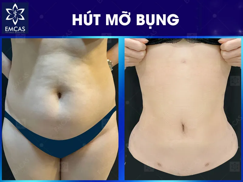 Để giảm nguy cơ hút mỡ bị lồi lõm, cần đánh giá đúng cơ địa và chất lượng da trước phẫu thuật, lựa chọn bác sĩ, công nghệ phù hợp và tuân thủ chăm sóc hậu phẫu theo chỉ định.