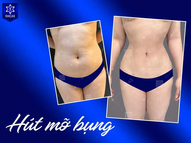 Tại Bệnh Viện Thẩm Mỹ EMCAS, khách hàng được thăm khám, đánh giá sức khỏe, lượng mỡ cần xử lý và xây dựng kế hoạch điều trị cá nhân hóa