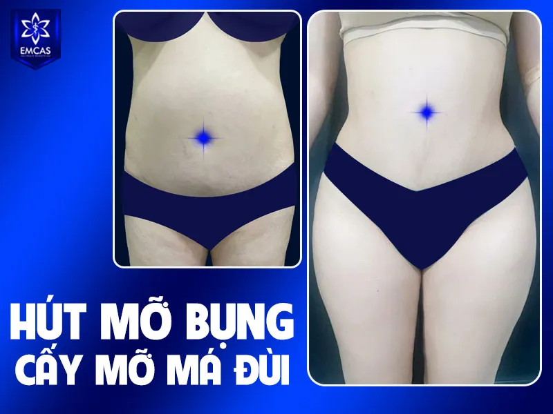 Không nên chọn hút mỡ bụng chỉ vì giá rẻ