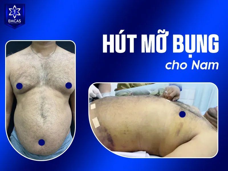 Chi phí hút mỡ bụng cho nam dao động từ 40.000.000 VNĐ đến hơn 100.000.000 VNĐ.