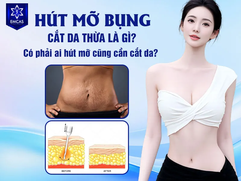 Không phải mọi trường hợp hút mỡ bụng đều cần cắt da thừa