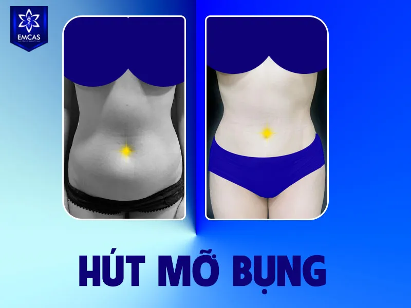 Bạn nên cân nhắc hút mỡ bụng tại Bệnh Viện Thẩm Mỹ EMCAS vì đây là bệnh viện chuyên khoa phẫu thuật thẩm mỹ