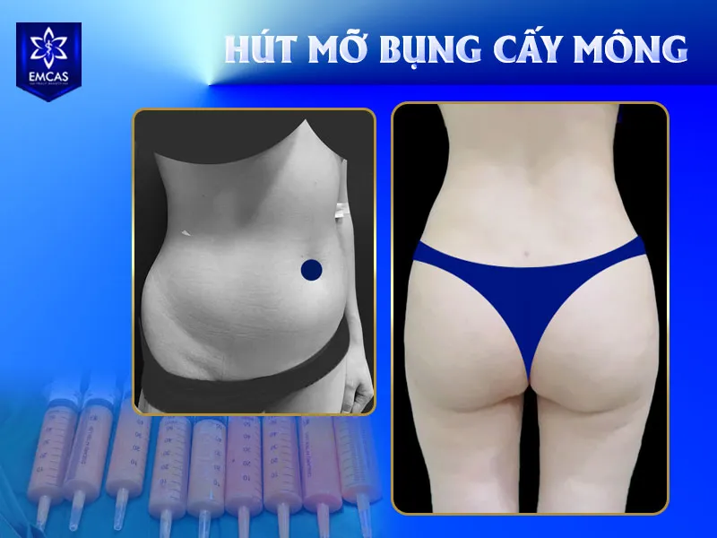chi phí hút mỡ bụng cấy mông dao động từ 40 triệu đến 125 triệu đồng trở lên.