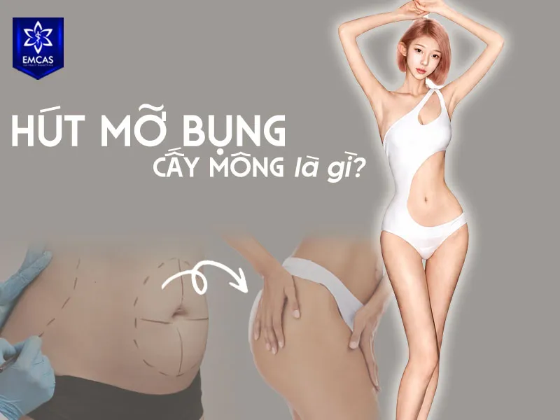 Hút mỡ bụng cấy mông là phương pháp kết hợp hút mỡ thừa vùng bụng, xử lý phần mỡ lấy ra và cấy mỡ tự thân vào vùng mông