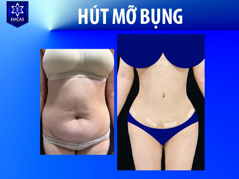 Tại Bệnh Viện Thẩm Mỹ EMCAS, hút mỡ bụng được chỉ định sau khi bác sĩ đánh giá thể trạng, lượng mỡ, chất lượng da và mức độ phù hợp của từng người