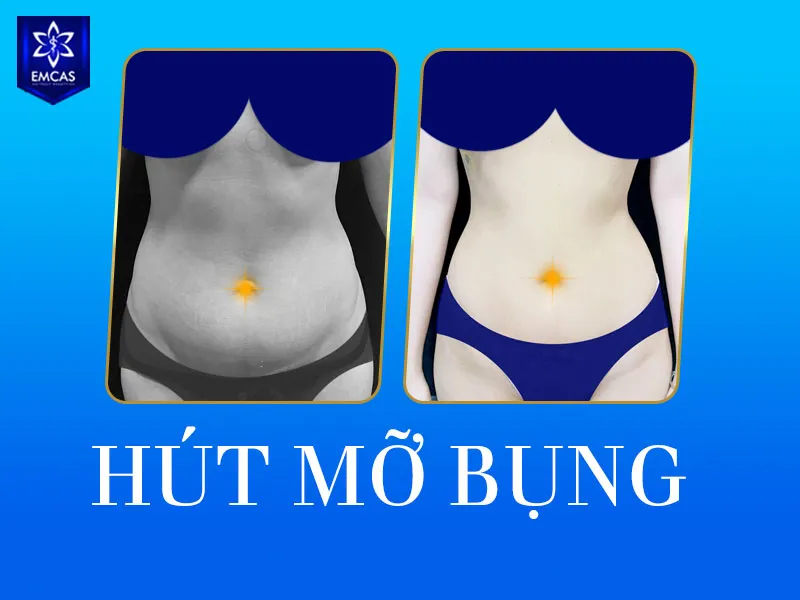 Trong thời gian chăm sóc sau hút mỡ bụng, ngoài việc quan tâm hút mỡ bụng phải nịt bụng bao lâu