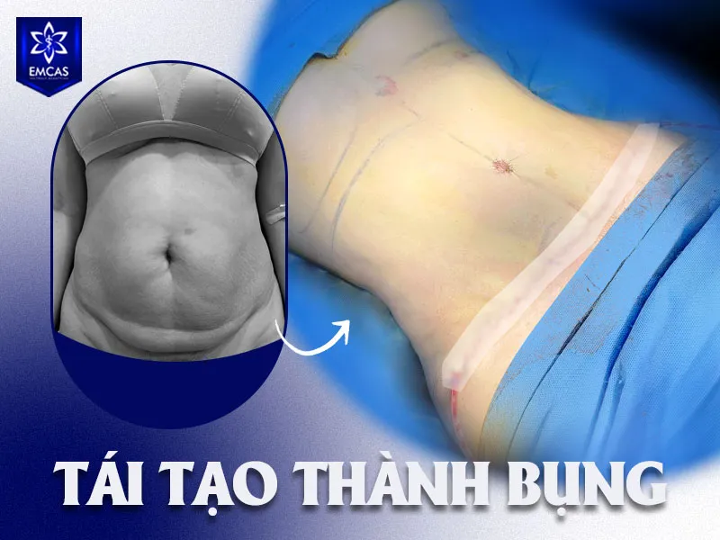 Tại Bệnh Viện Thẩm Mỹ EMCAS, kế hoạch hút mỡ bụng hoặc tái tạo thành bụng sau sinh cần bắt đầu bằng đánh giá riêng tình trạng mỡ, da, thành bụng, sức khỏe