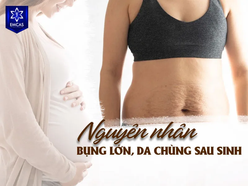 Bụng lớn hoặc da chùng sau sinh có thể xuất phát từ mỡ dưới da, tăng cân và mỡ nội tạng, da dư