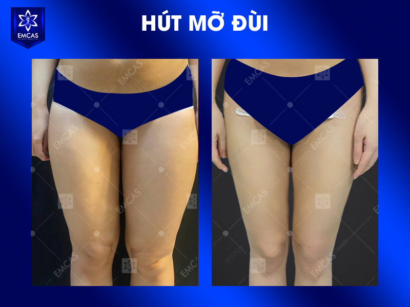 Người phù hợp để tư vấn hút mỡ thường có cân nặng tương đối ổn định nhưng vẫn còn vùng mỡ cục bộ khó cải thiện bằng ăn uống và vận động.