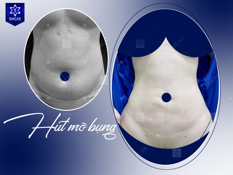 Tại Bệnh Viện Thẩm Mỹ EMCAS, bước đầu tiên không phải là quyết định hút mỡ ngay mà là thăm khám để bác sĩ đánh giá vùng mỡ, thể trạng và mục tiêu thực tế của từng người.