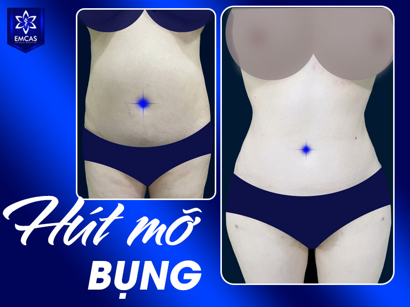 Bạn có thể cân nhắc thăm khám tại Bệnh Viện EMCAS nếu muốn được bác sĩ đánh giá trực tiếp về sức khỏe, lượng mỡ, vùng điều trị