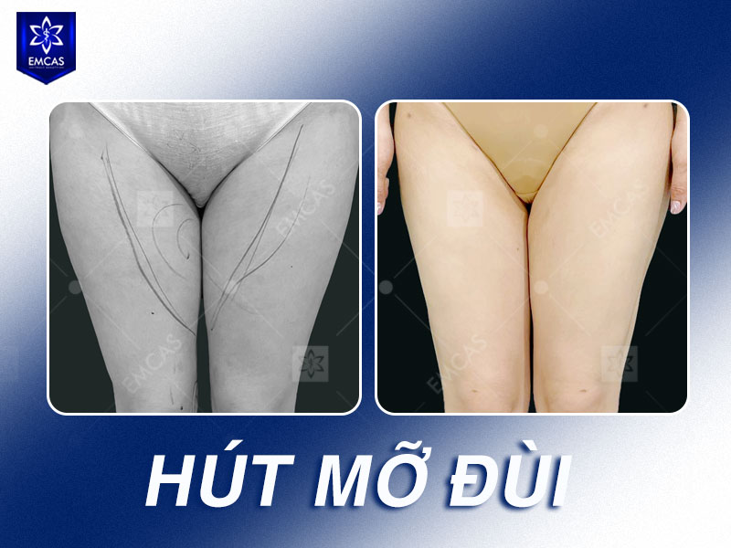 Nên chọn cơ sở hút mỡ dựa trên 4 yếu tố quan trọng gồm bác sĩ thực hiện, điều kiện gây mê hồi sức, hệ thống phòng mổ và khả năng theo dõi sau điều trị.