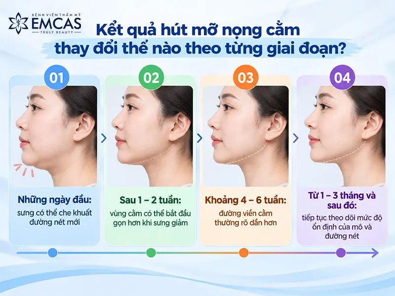 Kết quả sau hút mỡ nọng cằm xuất hiện dần khi tình trạng sưng giảm và vùng cằm ổn định hơn.