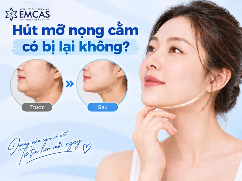 Long-term chin liposuction results and factors that may affect fullness under the chin