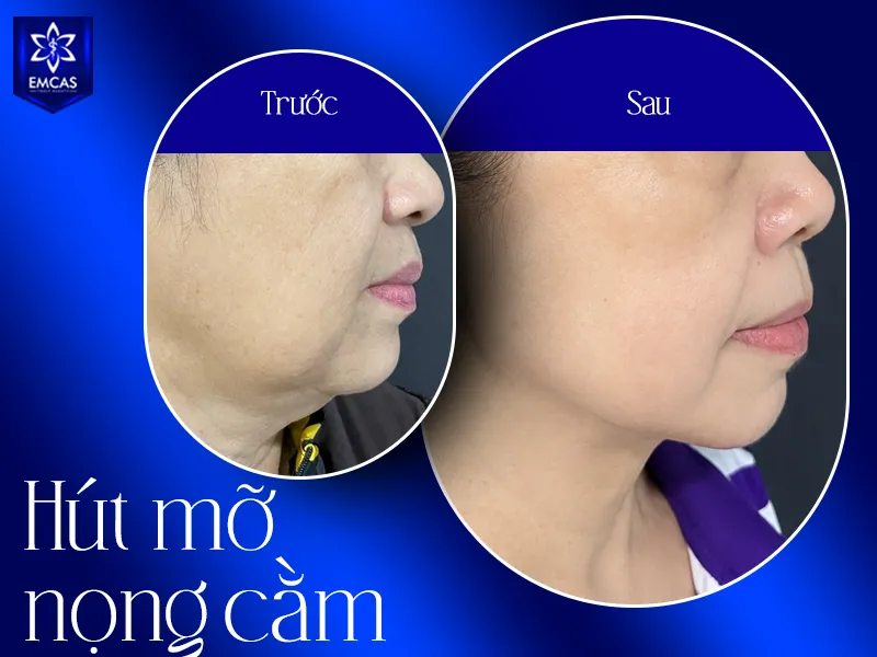 Đai định hình tạo lực ép và hỗ trợ nâng đỡ nhẹ lên vùng cằm