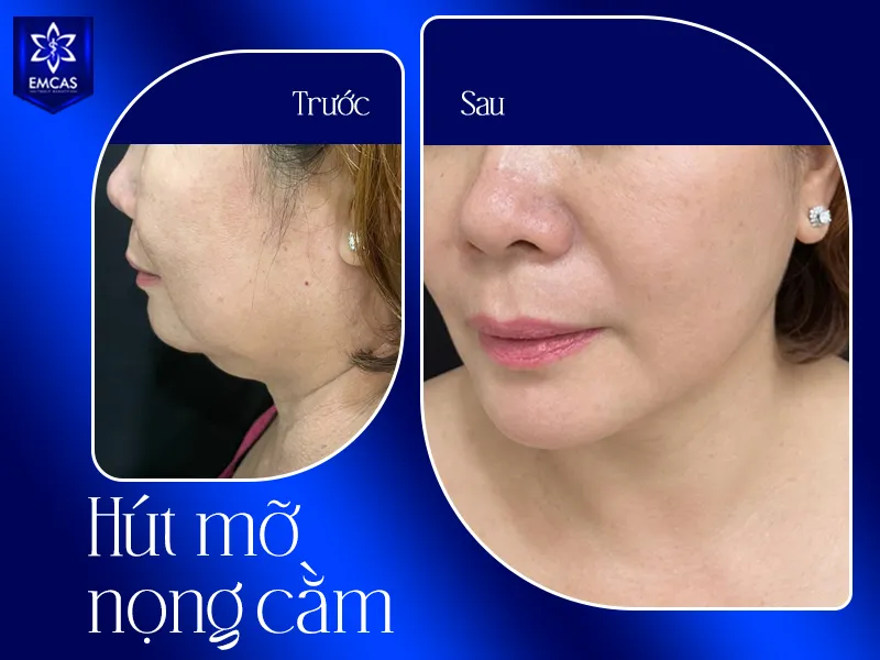 Hút mỡ nọng cằm an toàn tại Bệnh Viện Thẩm Mỹ EMCAS