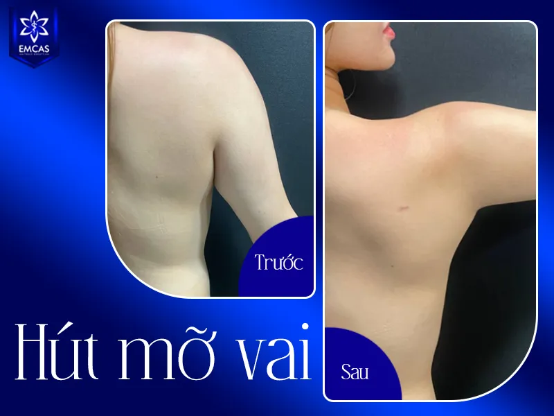 Điểm cần đánh giá khi lựa chọn nơi hút mỡ vai không chỉ là công nghệ mà gồm điều kiện pháp lý, bác sĩ thực hiện