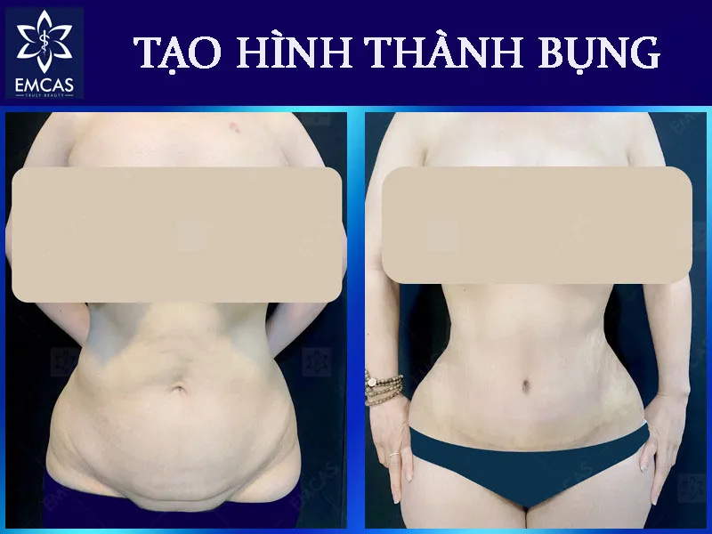 Nên cân nhắc thực hiện phẫu thuật tạo hình thành bụng sau khoảng 12 tháng