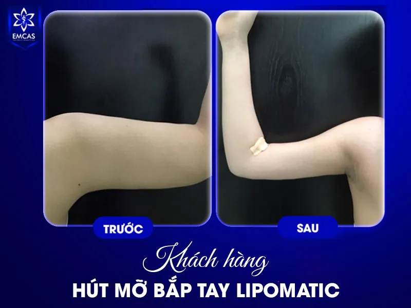 Để giảm phù nề sau hút mỡ an toàn, chị em nên mang gen đúng hướng dẫn, vận động nhẹ