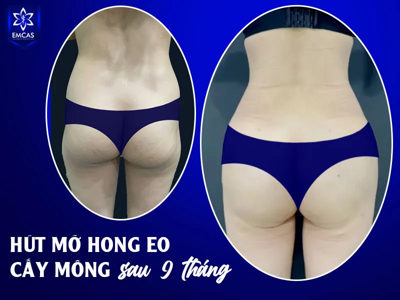 Quá trình hút mỡ không kết thúc sau phẫu thuật mà tiếp tục được theo dõi trong giai đoạn hồi phục.
