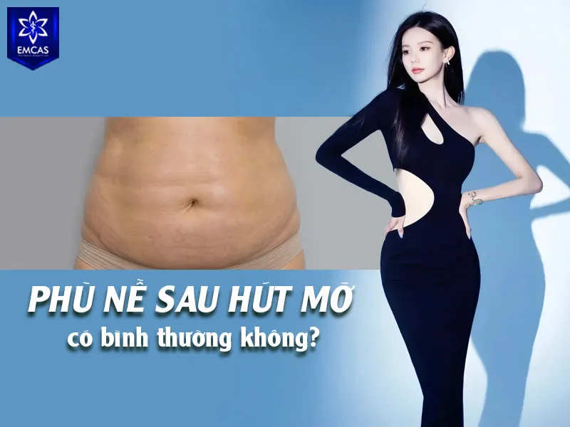 Phù nề sau hút mỡ thường là phản ứng hồi phục bình thường của cơ thể