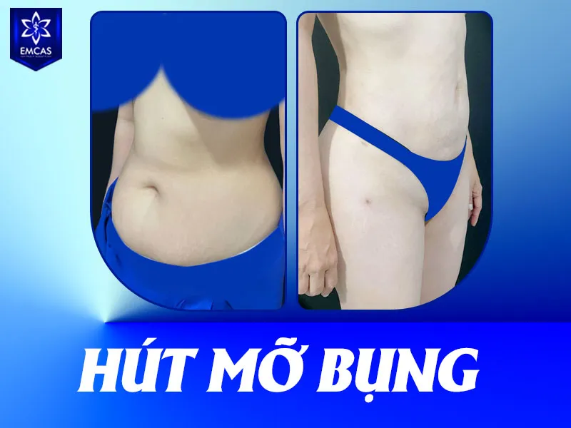 Thời gian phẫu thuật hút mỡ bụng thường mất khoảng 60 – 120 phút