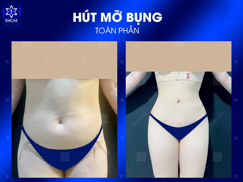 Tại Bệnh Viện Thẩm Mỹ EMCAS, giải pháp hút mỡ được xây dựng theo hướng cá nhân hóa