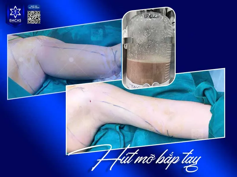 Một review hút mỡ bắp tay có kết quả đẹp không có nghĩa mọi người có bắp tay lớn đều phù hợp để hút mỡ