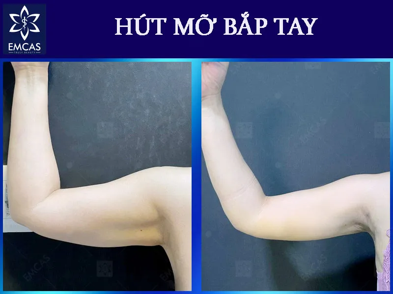 Hút mỡ bắp tay có thể để lại sẹo nhỏ tại vị trí bác sĩ tạo đường rạch để đưa dụng cụ qua da.