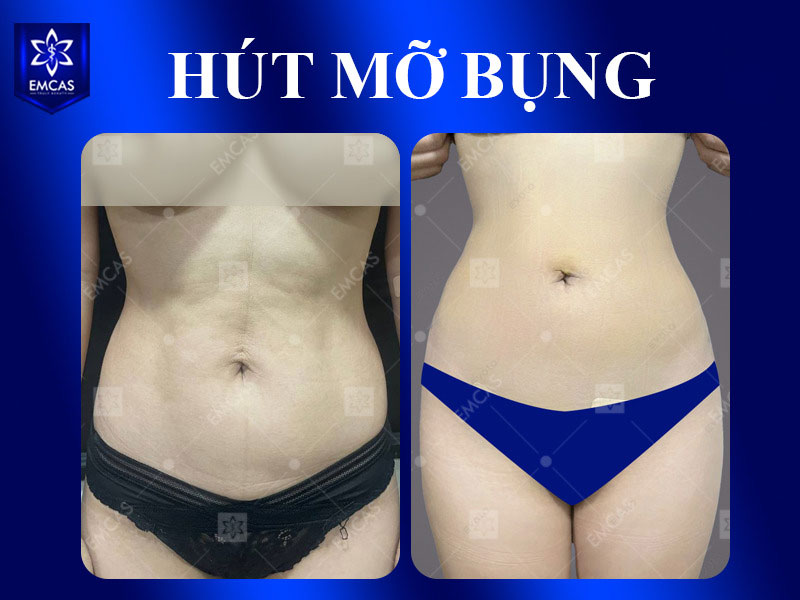 Tại Bệnh Viện Thẩm Mỹ EMCAS, nguy cơ sẹo sau hút mỡ được tiếp cận theo hướng cá nhân hóa thay vì đặt mục tiêu không sẹo.