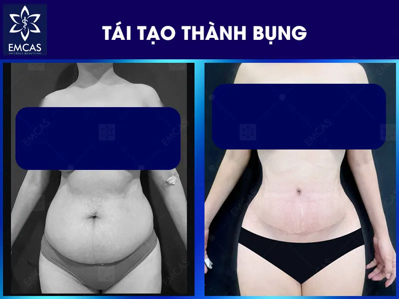 Tại Bệnh Viện Thẩm Mỹ EMCAS, kế hoạch tạo hình thành bụng bắt đầu từ việc đánh giá lượng da dư, tình trạng thành bụng