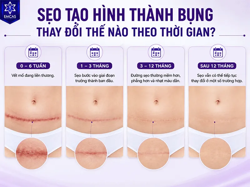 Sẹo tạo hình thành bụng không có hình dạng cuối cùng ngay sau mổ mà thay đổi qua nhiều tháng