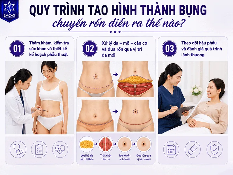 Quy trình tạo hình thành bụng chuyển rốn gồm 3 giai đoạn chính