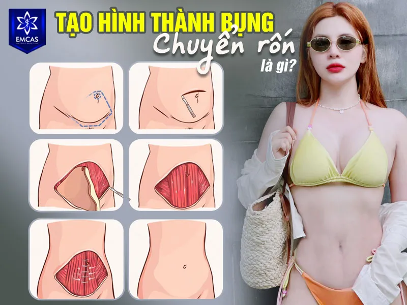 Tạo hình thành bụng chuyển rốn là cách gọi phổ biến của tạo hình thành bụng toàn phần