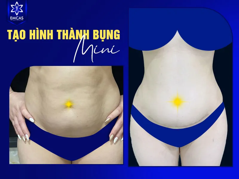 Tại Bệnh Viện Thẩm Mỹ EMCAS, hiệu quả của tạo hình thành bụng mini cần được review dựa trên tình trạng trước phẫu thuật