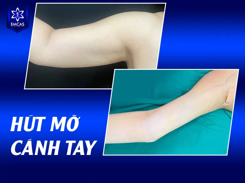 Để giảm nguy cơ tụ dịch sau hút mỡ, người bệnh cần tuân thủ hướng dẫn hậu phẫu của bác sĩ