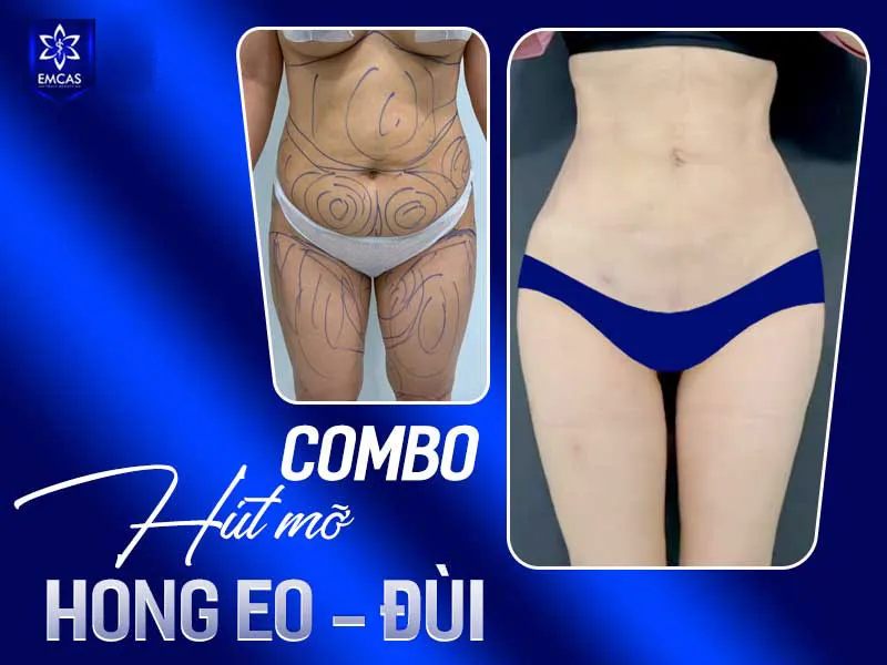 Tình trạng rỉ dịch và tụ dịch sau hút mỡ thường giảm dần và có thể hết hoàn toàn trong khoảng 5 – 10 ngày