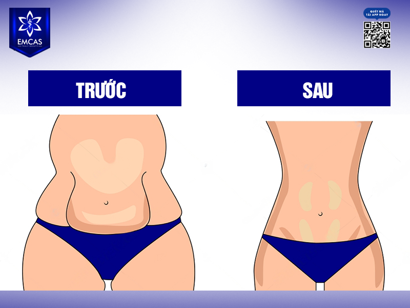 Hút Mỡ Bụng Có An Toàn Không?