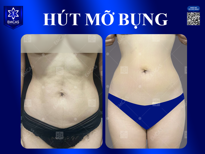 Nên Hút Mỡ Bụng, Đùi, Cánh Tay Hay Nọng Cằm Trước?