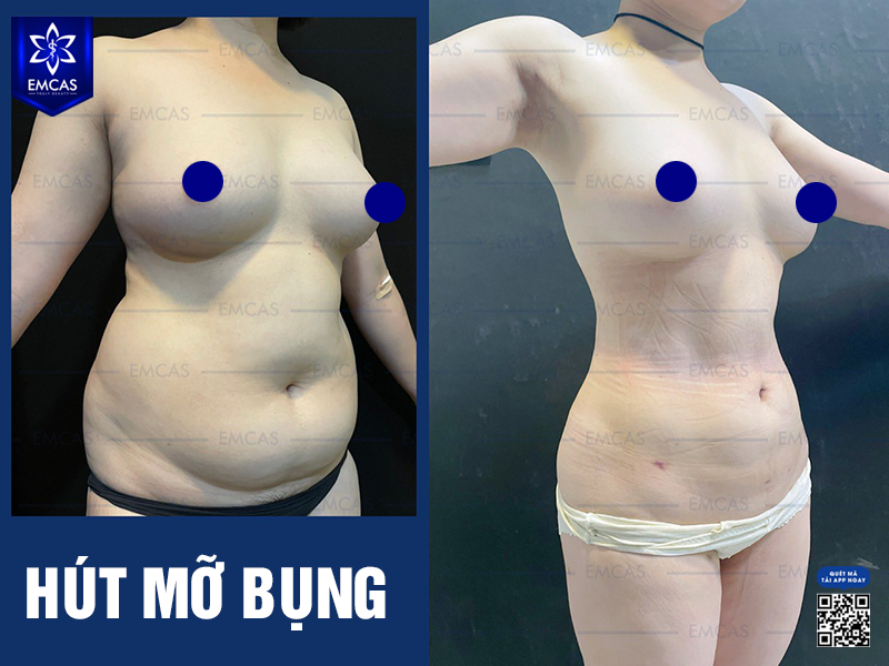 Hút Mỡ Bụng Có An Toàn Không?